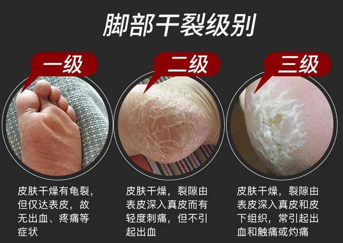 足部干裂修复全攻略：从成因到护理，重焕双足娇嫩